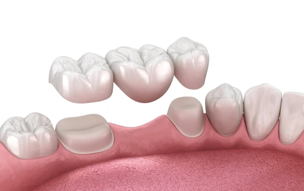 dental bridges in little italy, on
