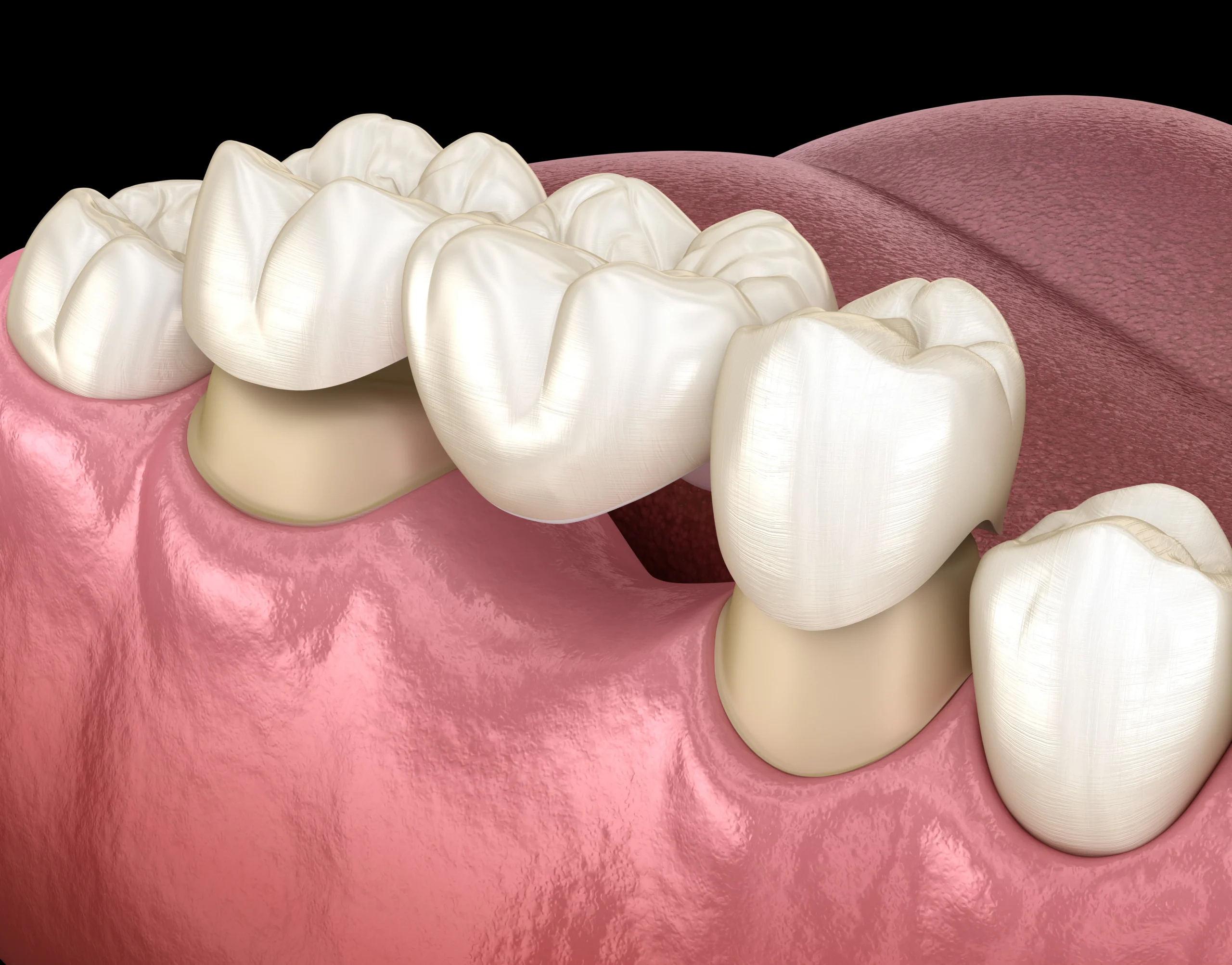 dental crowns in little italy, on