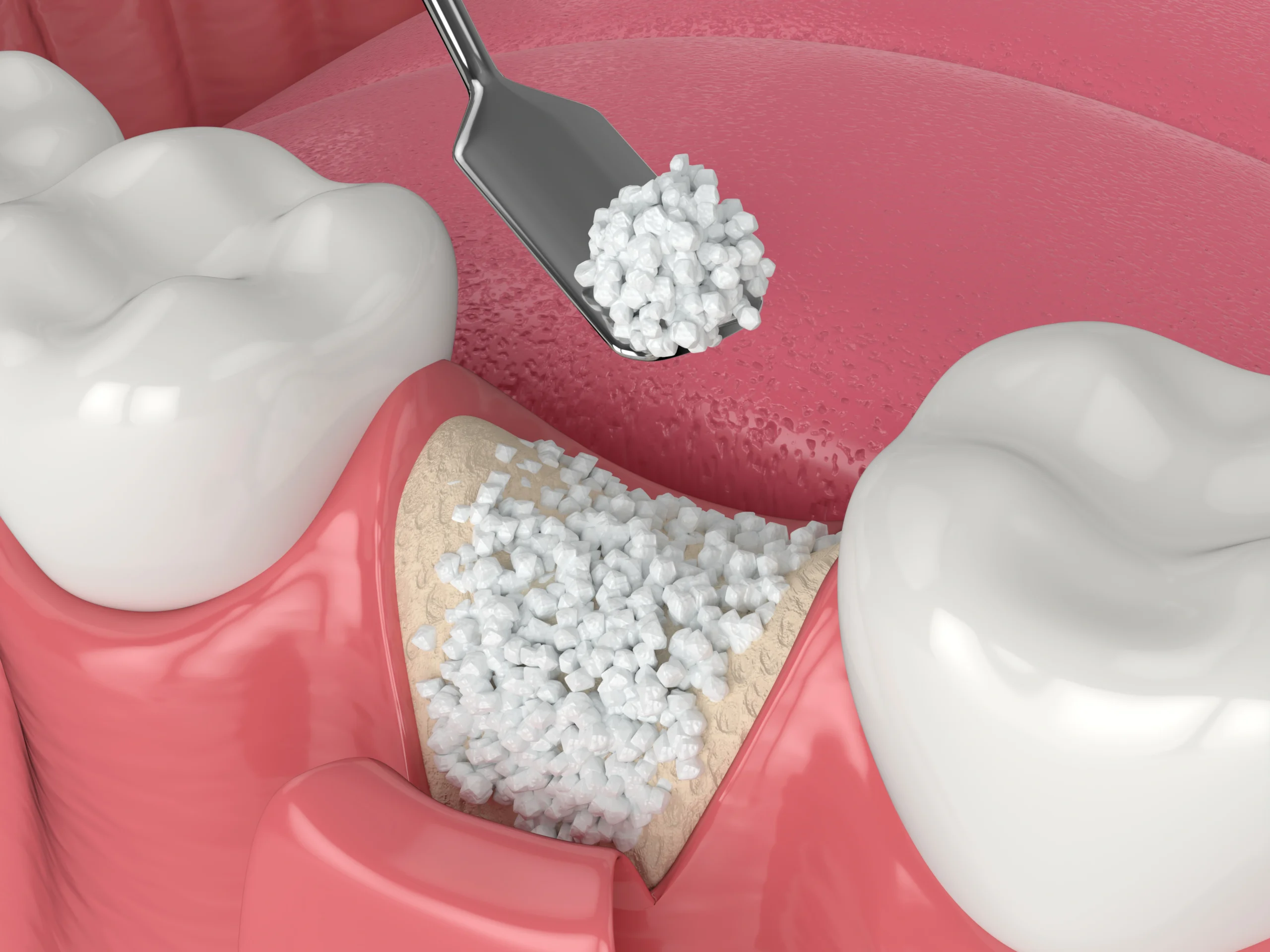 dental fillings in little italy, on