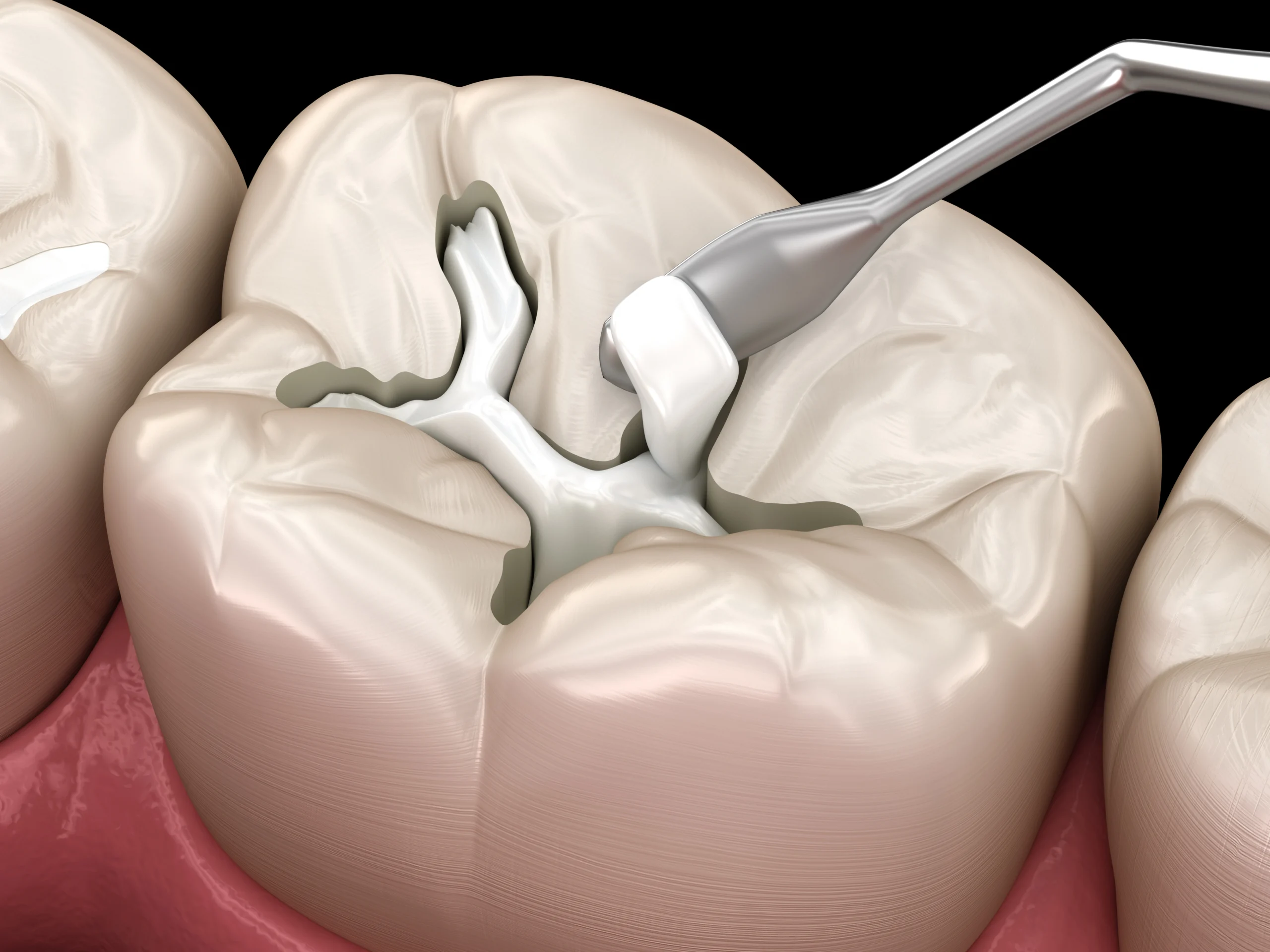 dental fillings near you