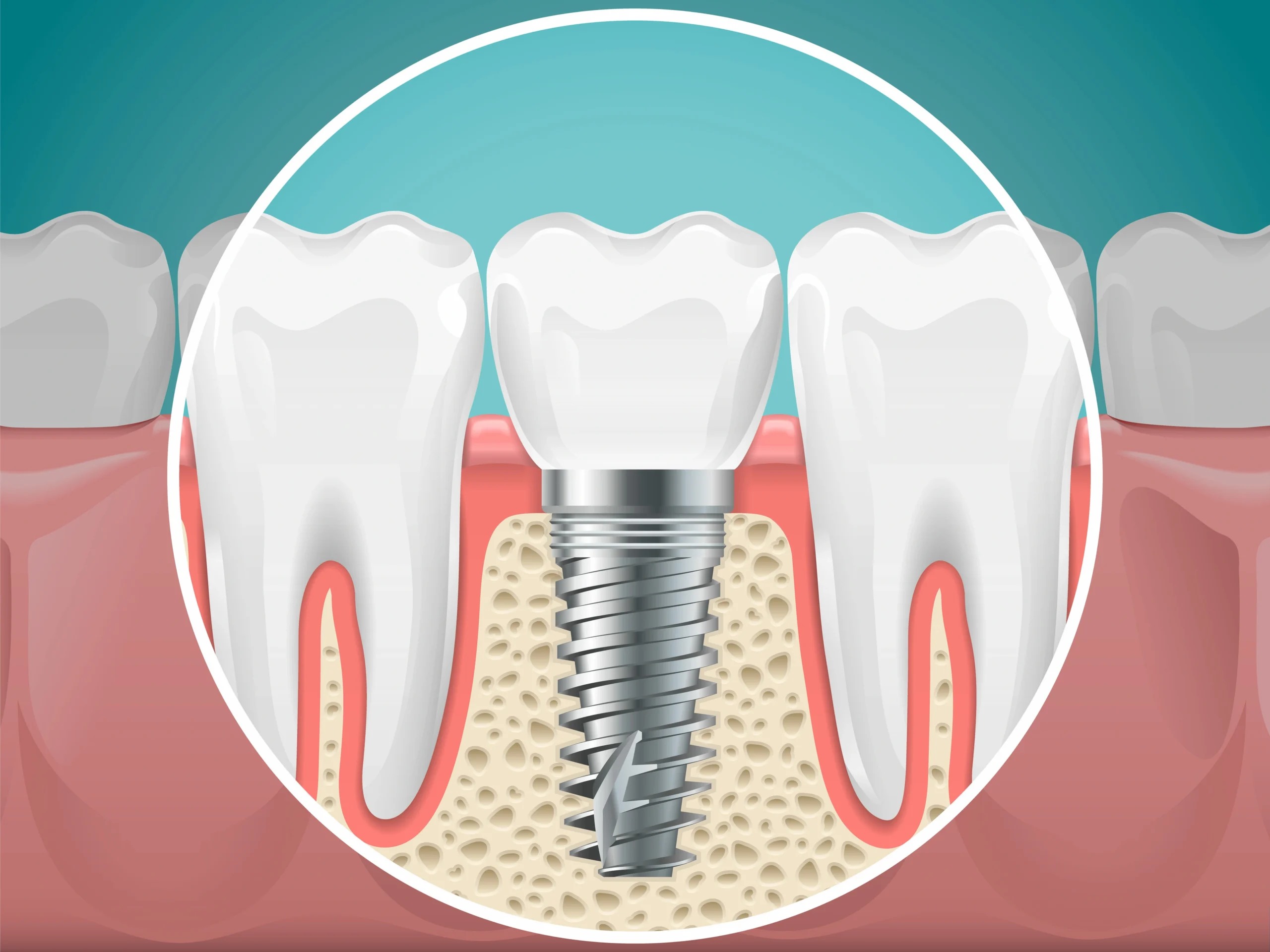 dental implants in little italy, on