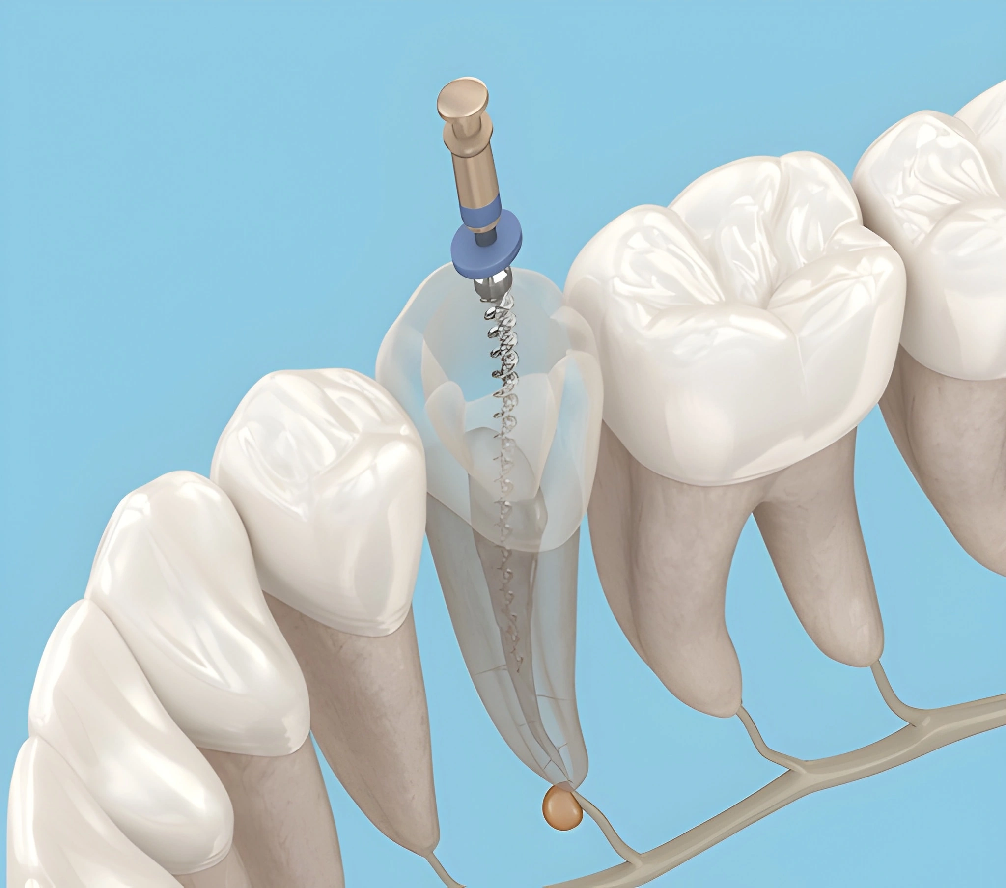root canal treatment in little italy, on