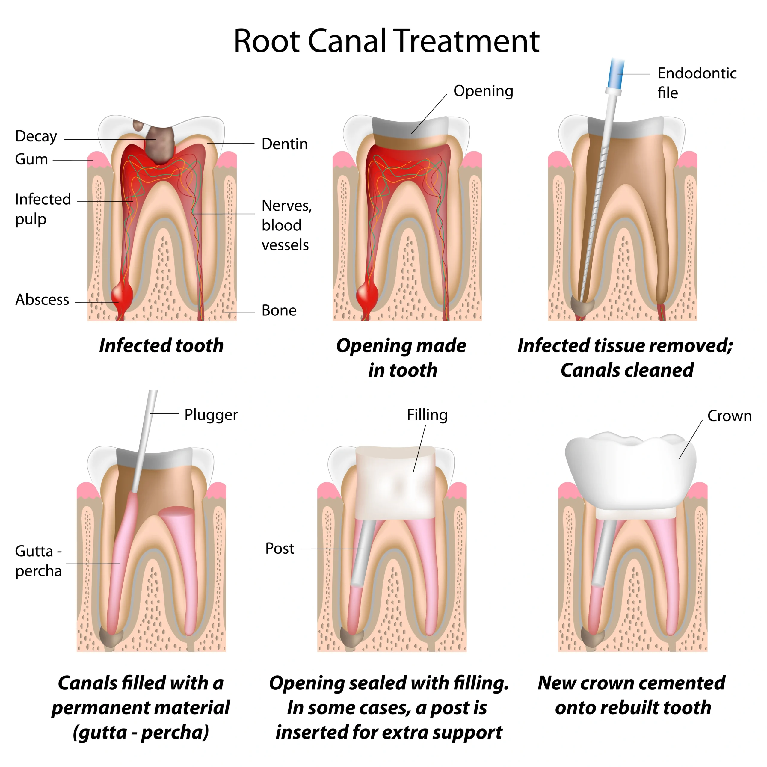 root canal treatment near you