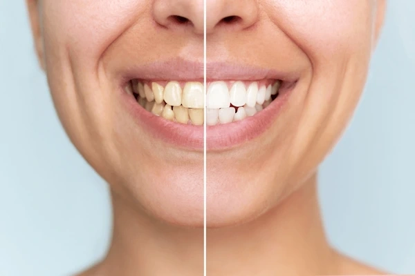teeth whitening in little italy, on