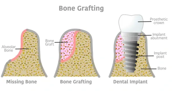 bone grafting near you