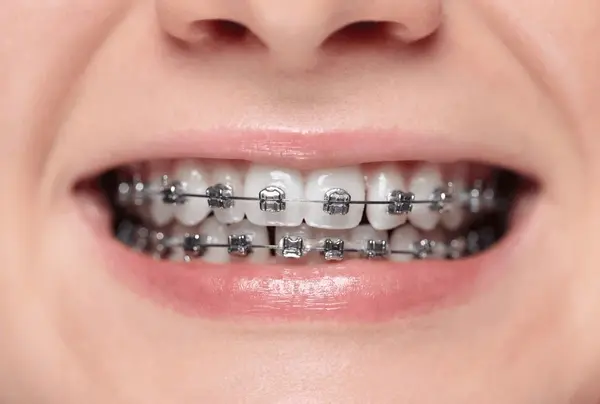 braces in little italy, on