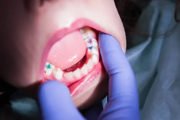 childrens dental fillings in little italy, on