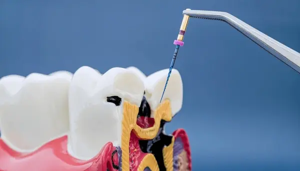 endodontic surgery in little italy