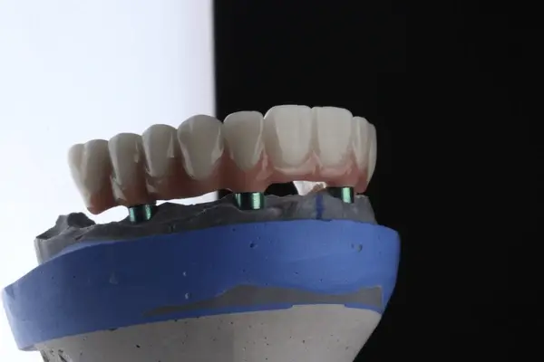 full mouth dental implants in little italy, on
