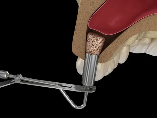 sinus lift in little italy, on