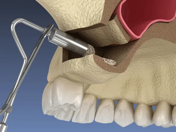 sinus lift near you