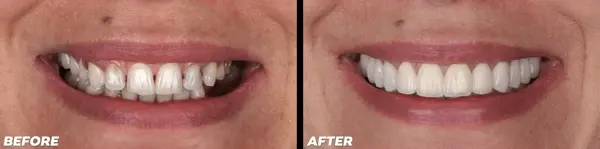 smile makeovers in little italy, on