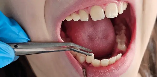 tooth extractions in little italy, on